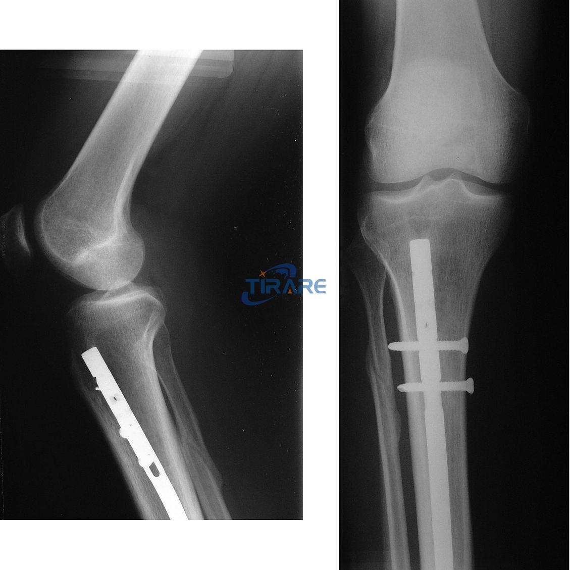 Titanium rod in leg